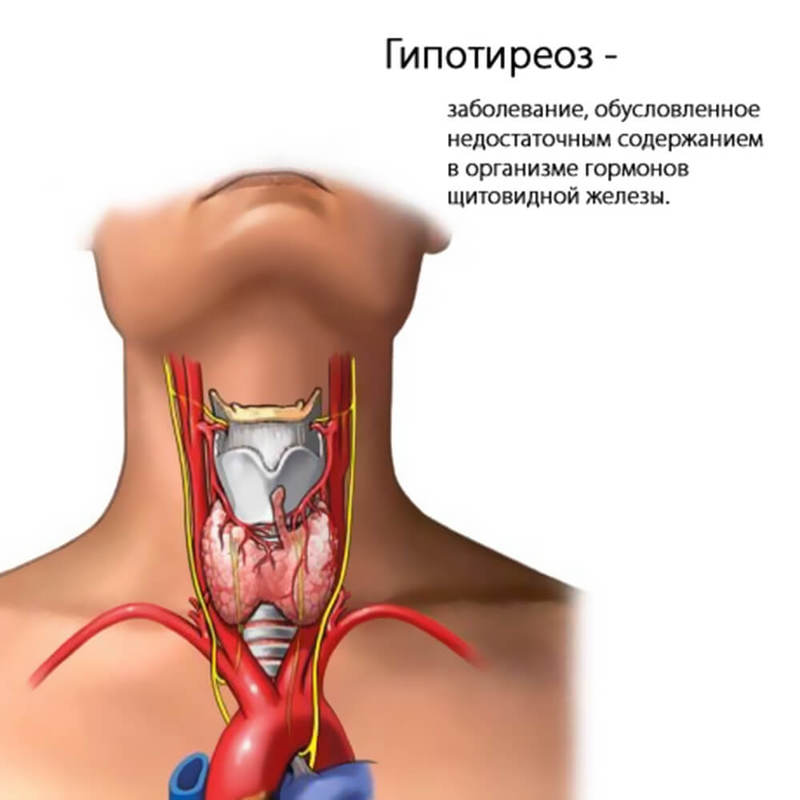 Щитовидная железа: Субклиническая дисфункция