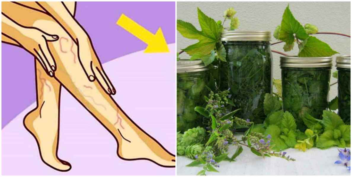 10 рецептов лечения варикоза и тромбофлебита травами, что растут под ногами